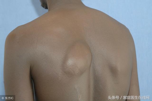 脂肪瘤是什么原因造成的?不避开3个诱因,下一个就找上你