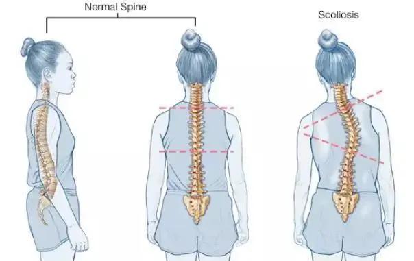 比驼背、骨盆前倾还毁身材的它,有多恐怖你知道吗?