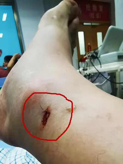 �㽭����ɢ��ʱ���綾��ҧ��һ�ڣ�������ͷ���̿���ʽ�����Ծȳɹ�